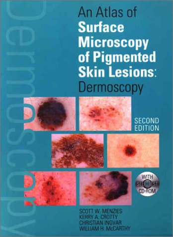 Atlas of Surface Microscopy of Pigmented Skin Lesions: Dermoscopy, Second Edition  2nd 2002 (Revised) 9780074711026 Front Cover