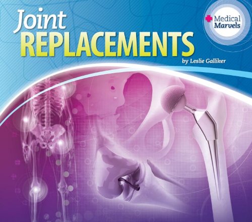 Joint Replacements:   2013 9781617839030 Front Cover