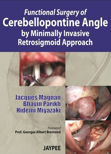 Functional Surgery of Cerebellopontine Angle by Minimally Invasive Retrosigmoid Approach   2013 9789350905258 Front Cover