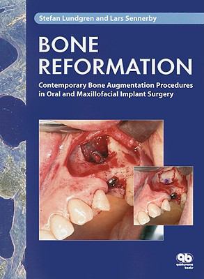 BONE REFORMATION: Contemporary Bone Augmentation Procedures in Oral and Maxillofacial Implant  2008 9781850971573 Front Cover