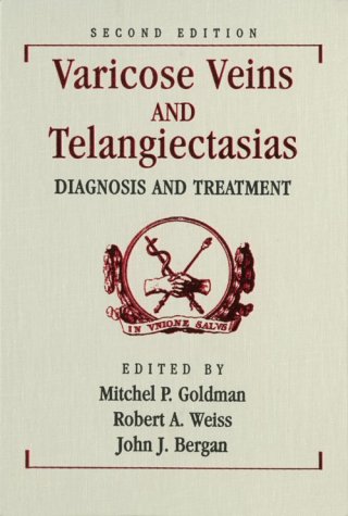 Varicose Veins and Telangiectasias Diagnosis and Treatment 2nd 1999 (Revised) 9781576260975 Front Cover