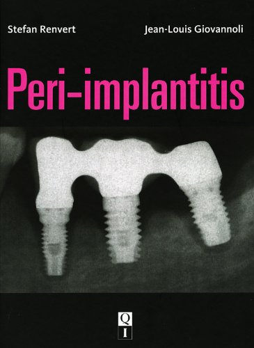 Peri-implantitis:  2012 9782912550989 Front Cover