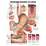 Understanding Ulcers Anatomical Chart  9781587793707 Front Cover